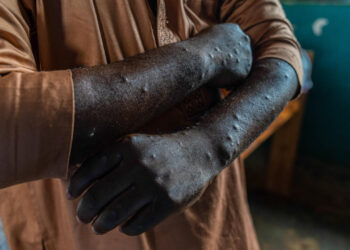 Mu Bufaransa hagaragaye umuntu wa mbere wagaragayeho ubwoko bushya bwa Monkeypox buzwi nka Clade 1b