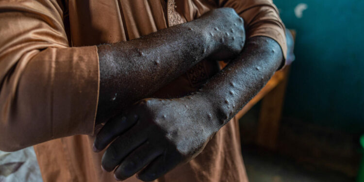 Mu Bufaransa hagaragaye umuntu wa mbere wagaragayeho ubwoko bushya bwa Monkeypox buzwi nka Clade 1b