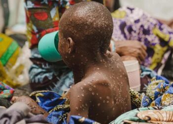 Icyorezo cy’ubushita bw’inkende gikomeje kwibasira abaturage bo muri RDC