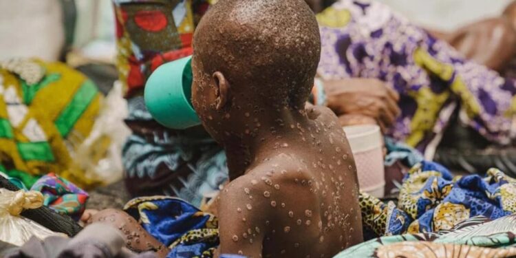 Icyorezo cy’ubushita bw’inkende gikomeje kwibasira abaturage bo muri RDC