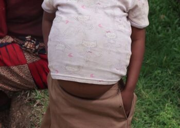 Kamonyi: Umwana w’imyaka itanu y’amavuko akomeje gutabarizwa kubera ikibazo cyo kubyimba inda