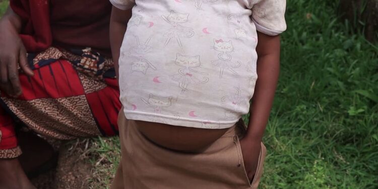 Kamonyi: Umwana w’imyaka itanu y’amavuko akomeje gutabarizwa kubera ikibazo cyo kubyimba inda